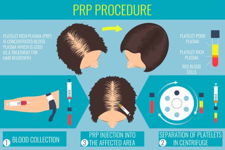 prp injections scalp regeneration platelet stimulation understandings